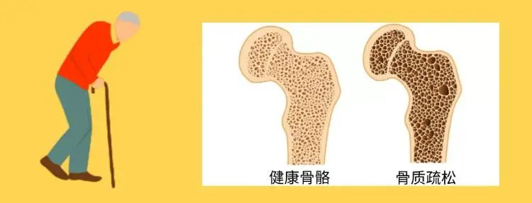世界骨质疏松日 | 强身健骨 远离骨折